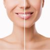 Aumento de Labios